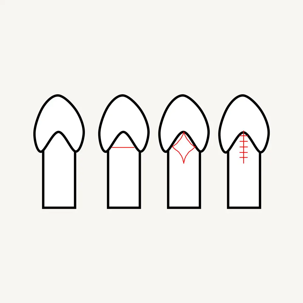 diagram of frenuloplasty at Circumcision Centre Ireland